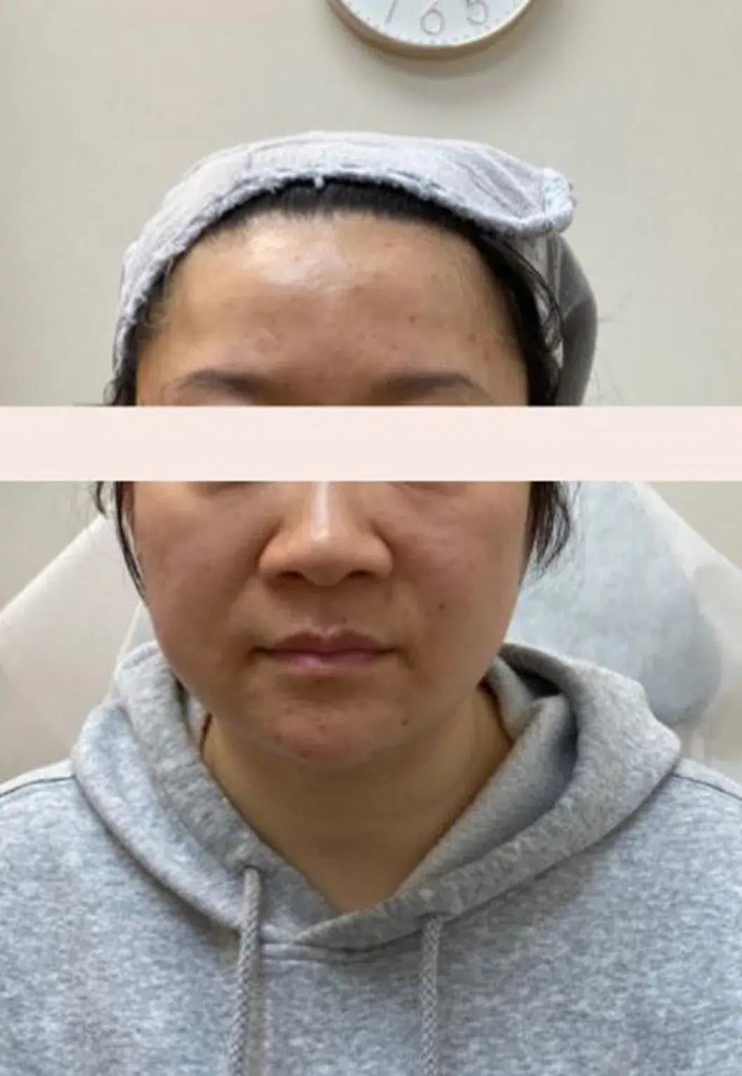 Forehead Hollowing — Before · Case 1 · Luowei Medical Aesthetics Clinic