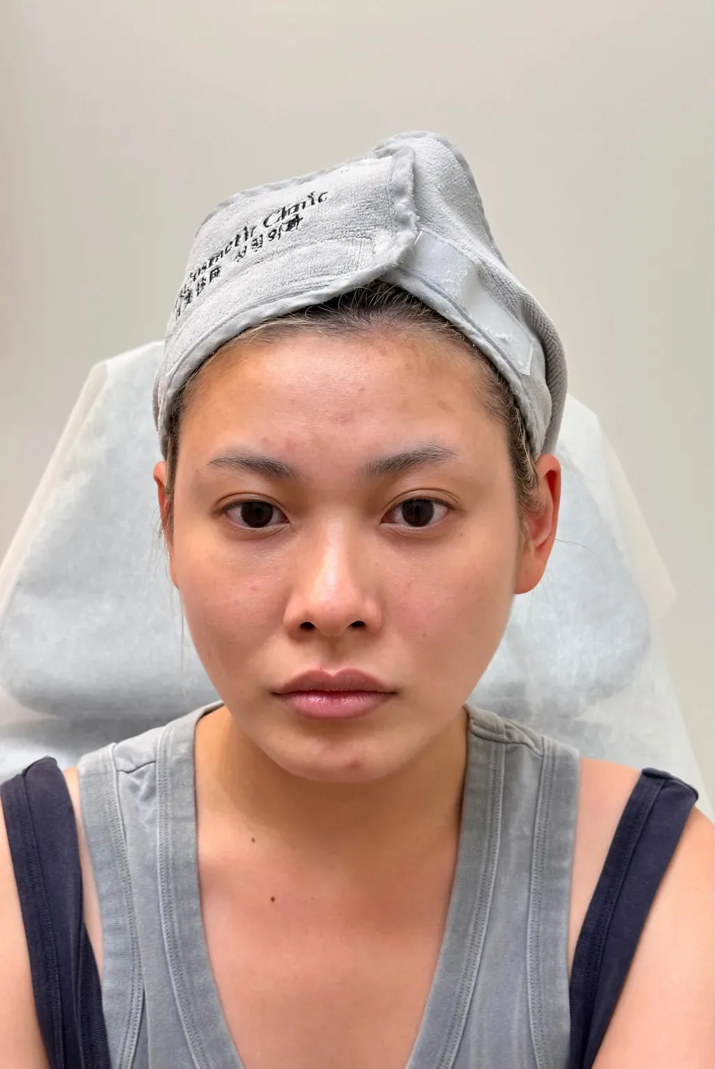 Lip Augmentation — Before · Case 02 · Luowei Medical Aesthetics Clinic