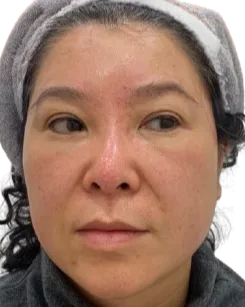Forehead lines — After Treatment · Case 7 · Luowei Medical Aesthetics Clinic