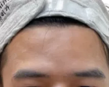 Forehead Lines — After Treatment · Case 5 · Luowei Medical Aesthetics Clinic