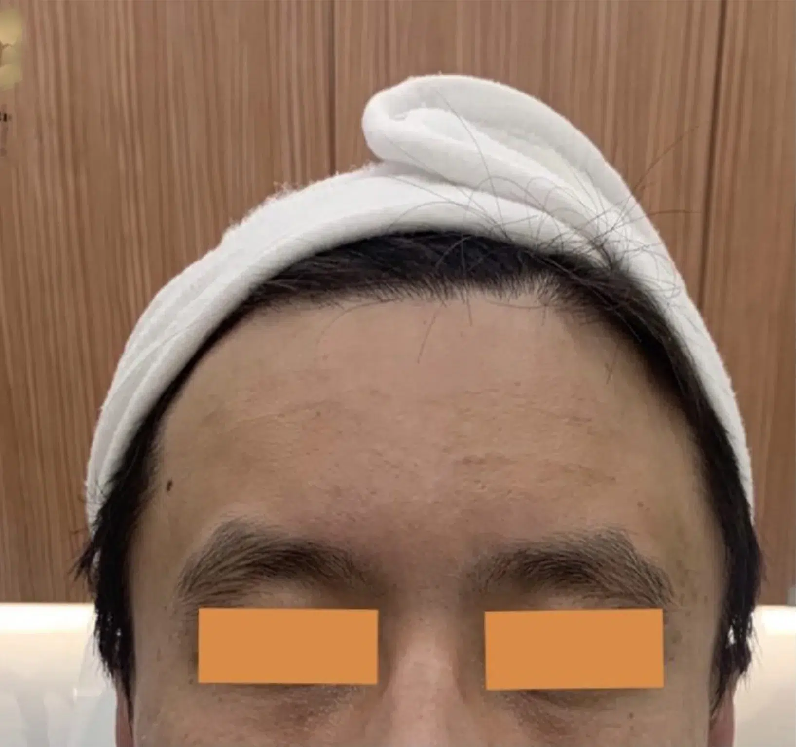 Forehead Lines — After · Case 14 · Luowei