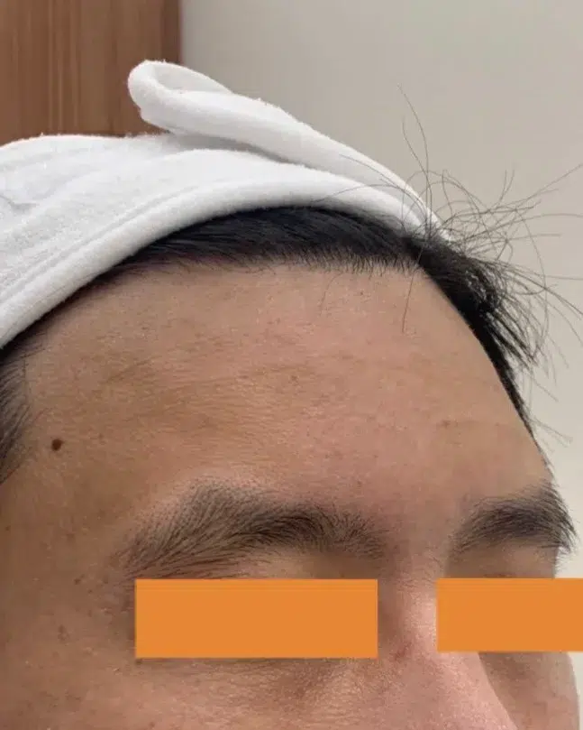 Forehead lines · After · Case 17 · Luowei Medical Aesthetics Clinic