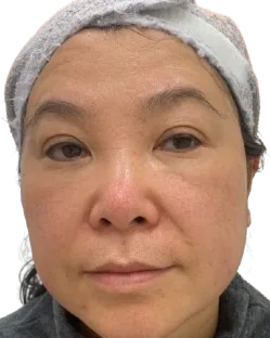 Forehead Lines — Before · Case 7 · Luowei Medical Aesthetics Clinic