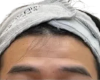 Forehead Lines — Before Treatment · Case 5 · Luowei Medical Aesthetics Clinic