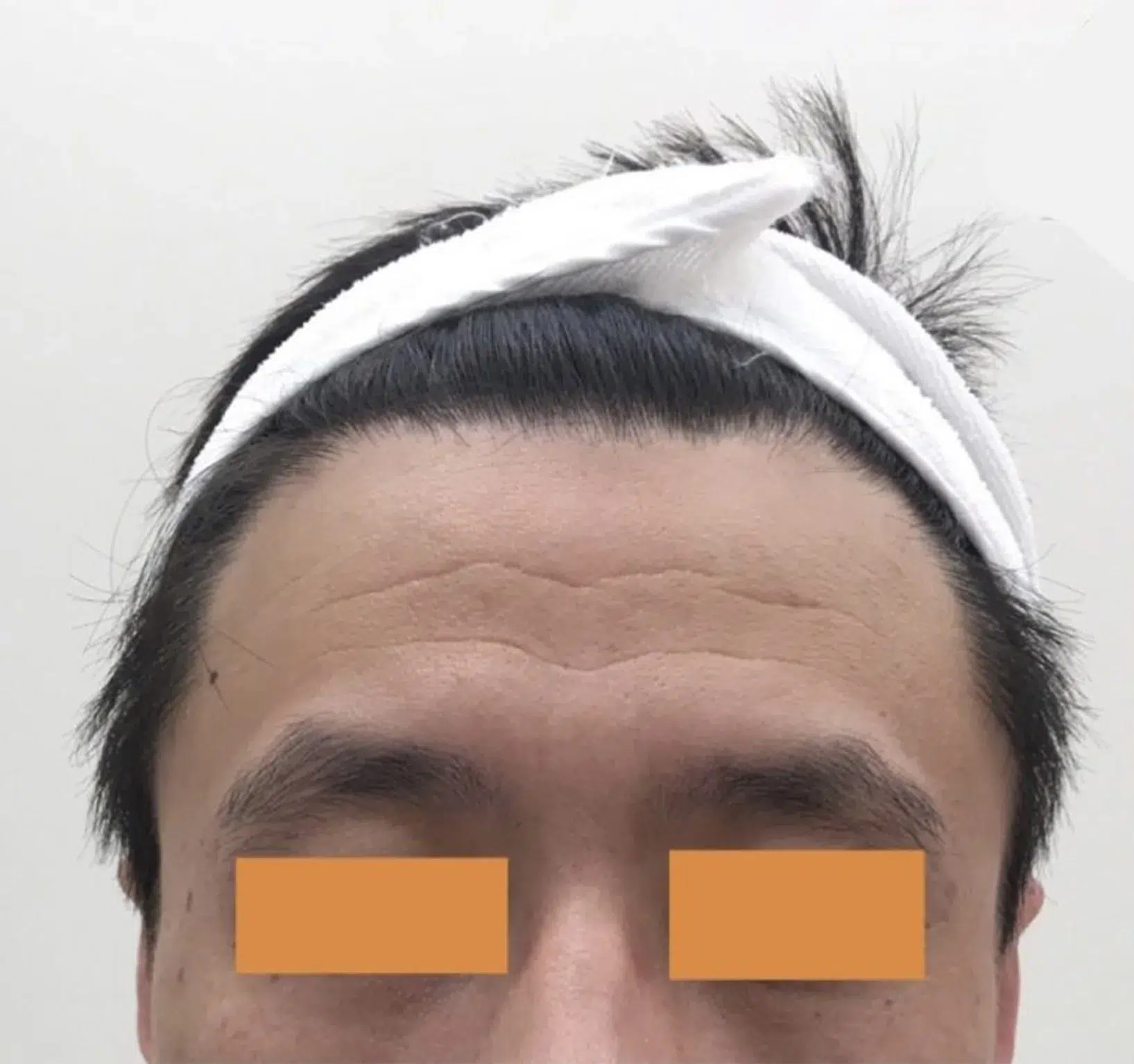 Forehead lines · Before · Case 14 · Luowei Medical Aesthetics Clinic