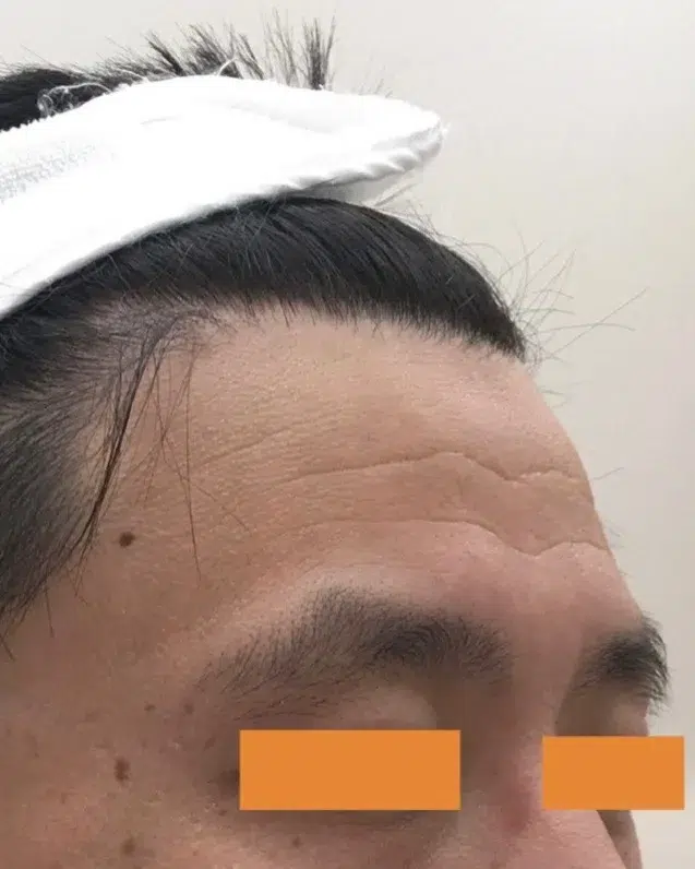 Forehead lines — Before · Case 17 · Luowei