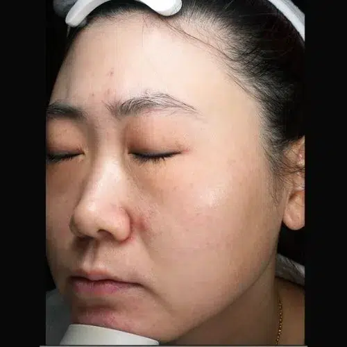 Pigmentation post-treatment · Case 03 · Luowei Medical Aesthetics Clinic