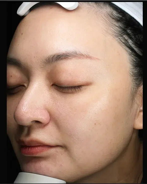 Sun Damage / Photoaging After-Treatment · Case 04 · Luowei Medical Aesthetics Clinic