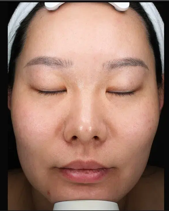 Sun Damage / Photoaging after · Case 05 · Luowei Medical Aesthetics Clinic