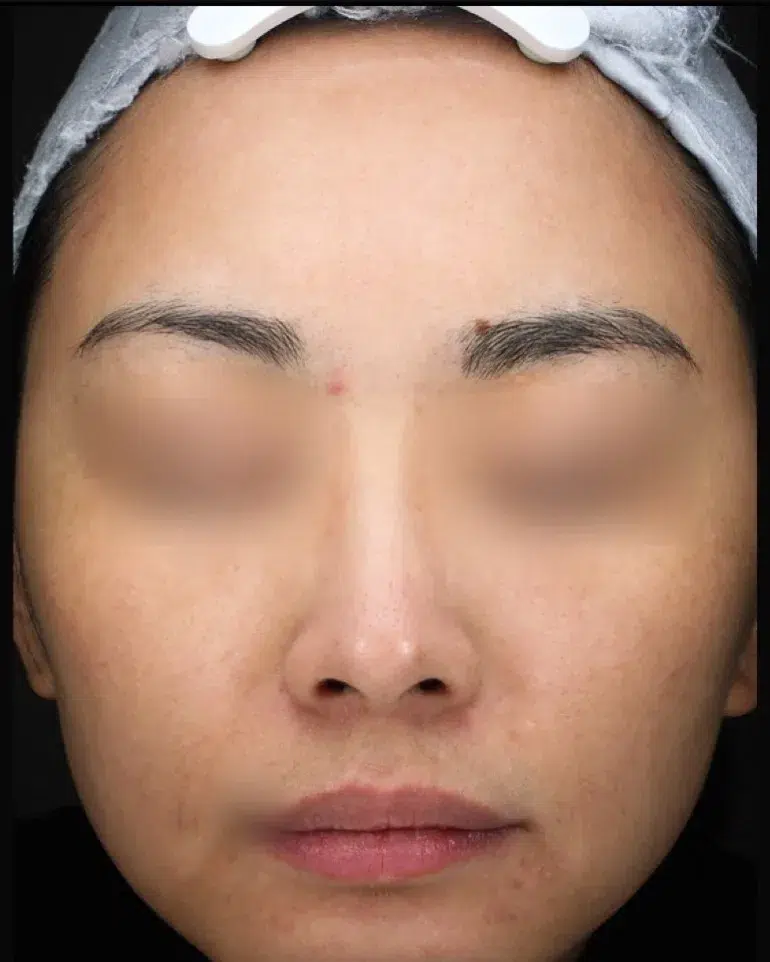 Sun Damage / Photoaging After · Case 07 · Luowei Medical Aesthetics Clinic