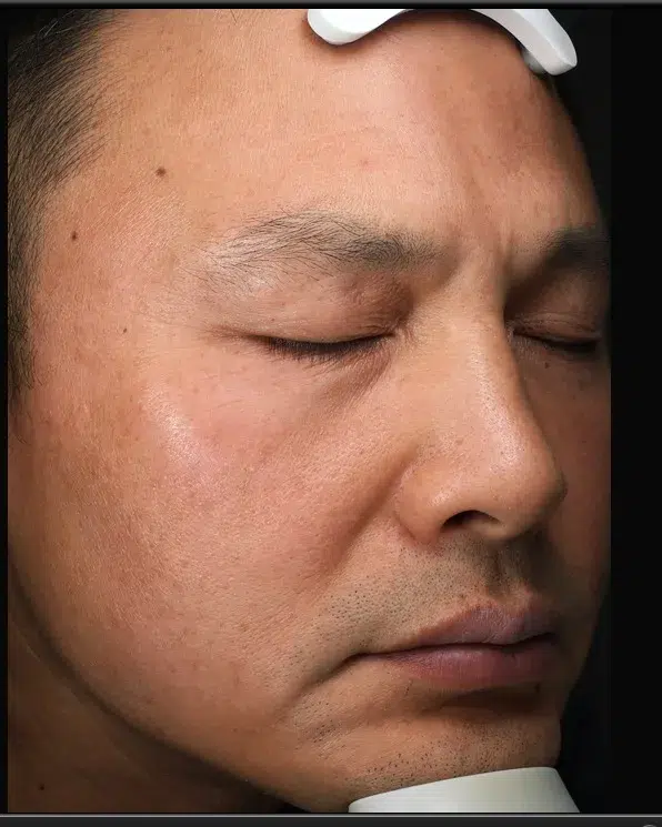 Sun Damage / Photoaging After-Treatment · Case 09 · Luowei Medical Aesthetics Clinic