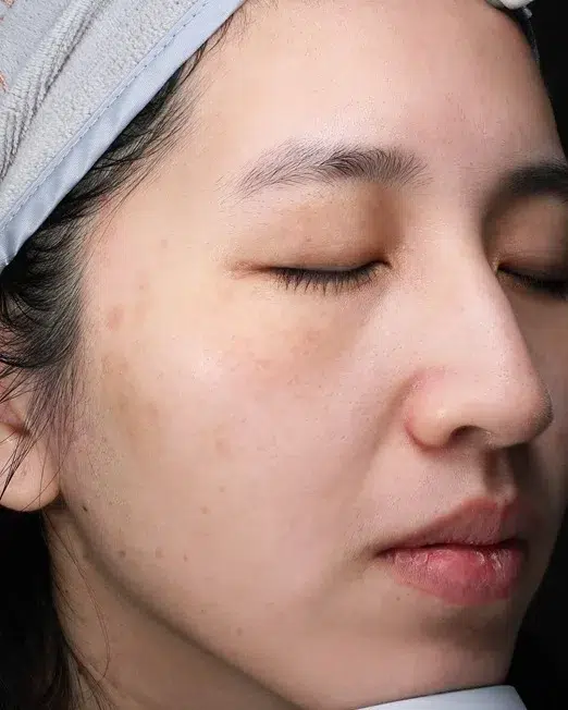 Freckles After Treatment · Case 24 · Luowei Medical Aesthetics Clinic