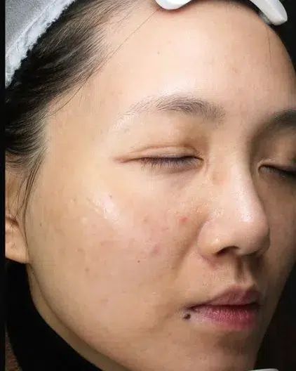 Pigmentation After · Case 12 · Luowei Medical Aesthetics Clinic
