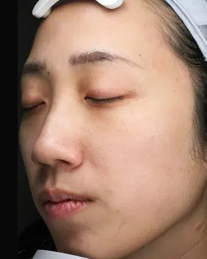 Hyperpigmentation After · Case 13 · Luowei Medical Aesthetics Clinic