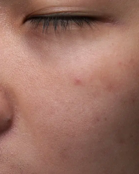 Freckles — After Treatment · Case 30 · Luowei Medical Aesthetics Clinic