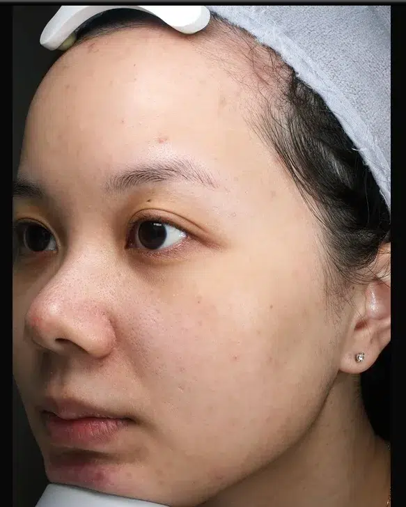 Hyperpigmentation After · Case 16 · Luowei Medical Aesthetics Clinic