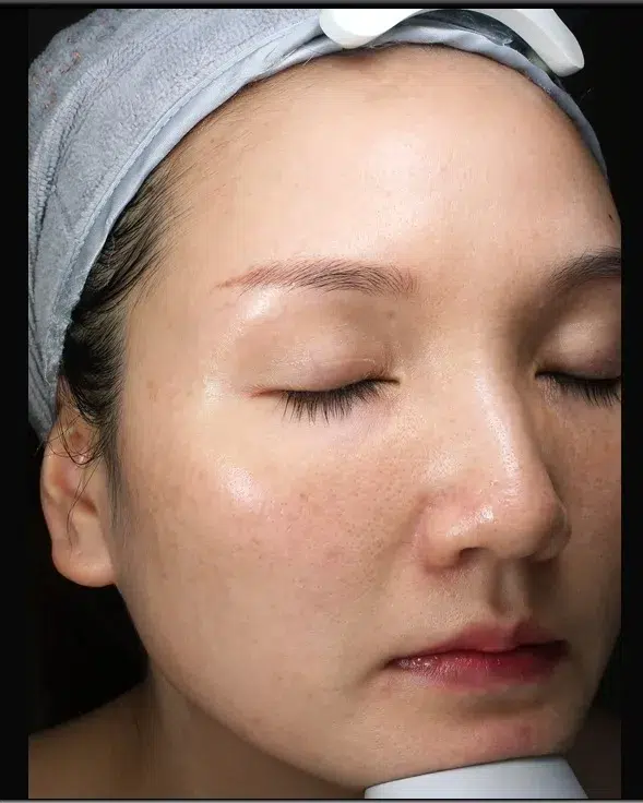 Sun Damage / Photoaging after · Case 17 · Luowei Medical Aesthetics Clinic