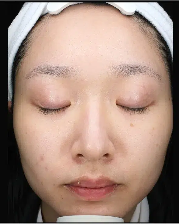 Freckle Treatment After · Case 19 · Luowei Medical Aesthetics Clinic