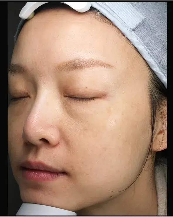Sun Damage / Photoaging After · Case 19 · Luowei Medical Aesthetics Clinic