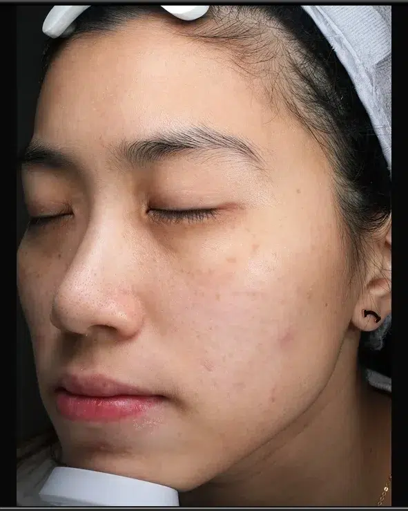 Sun Damage / Photoaging After-Treatment · Case 20 · Luowei Medical Aesthetics Clinic