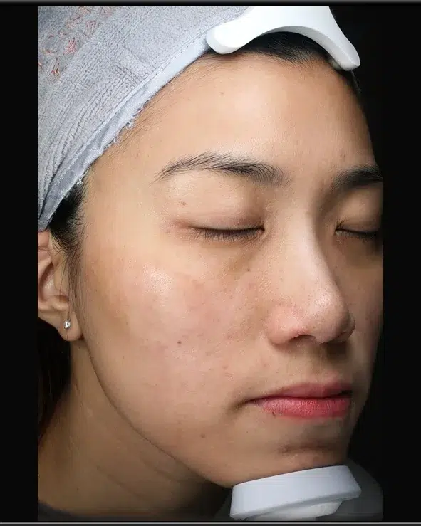 Post-Inflammatory Hyperpigmentation — After Treatment · Case 21 · Luowei Medical Aesthetics Clinic
