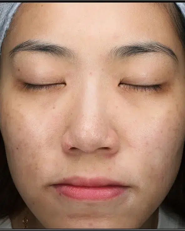Post-Inflammatory Hyperpigmentation — After Treatment · Case 22 · Luowei Medical Aesthetics Clinic