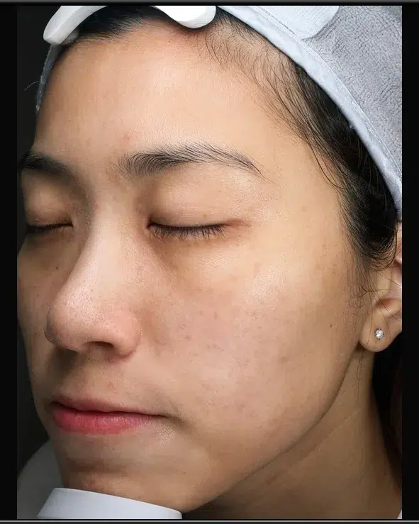 Freckle Treatment After · Case 26 · Luowei Medical Aesthetics Clinic