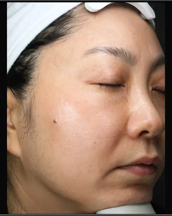 Sun Damage / Photoaging After-Treatment · Case 29 · Luowei Medical Aesthetics Clinic