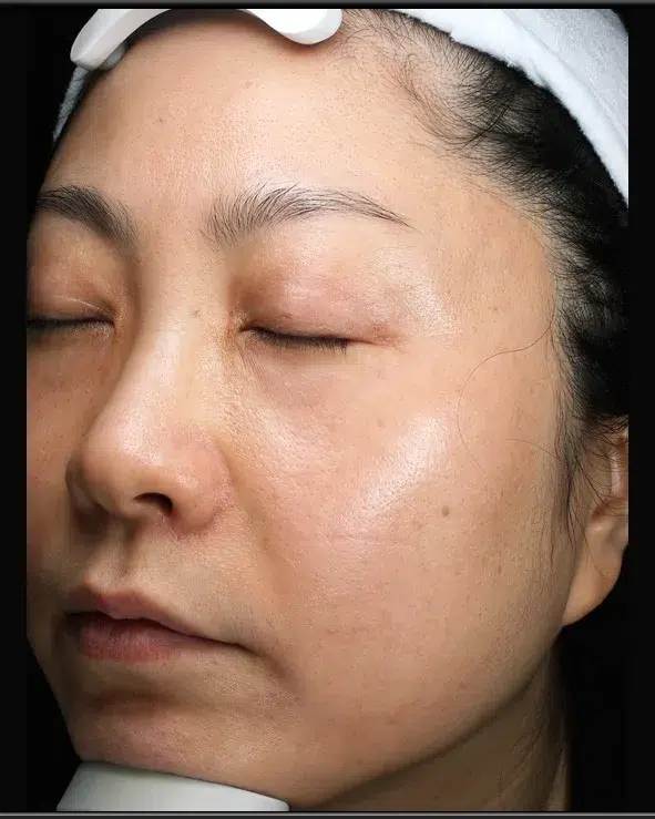 Sun Damage / Photoaging after · Case 31 · Luowei Medical Aesthetics Clinic
