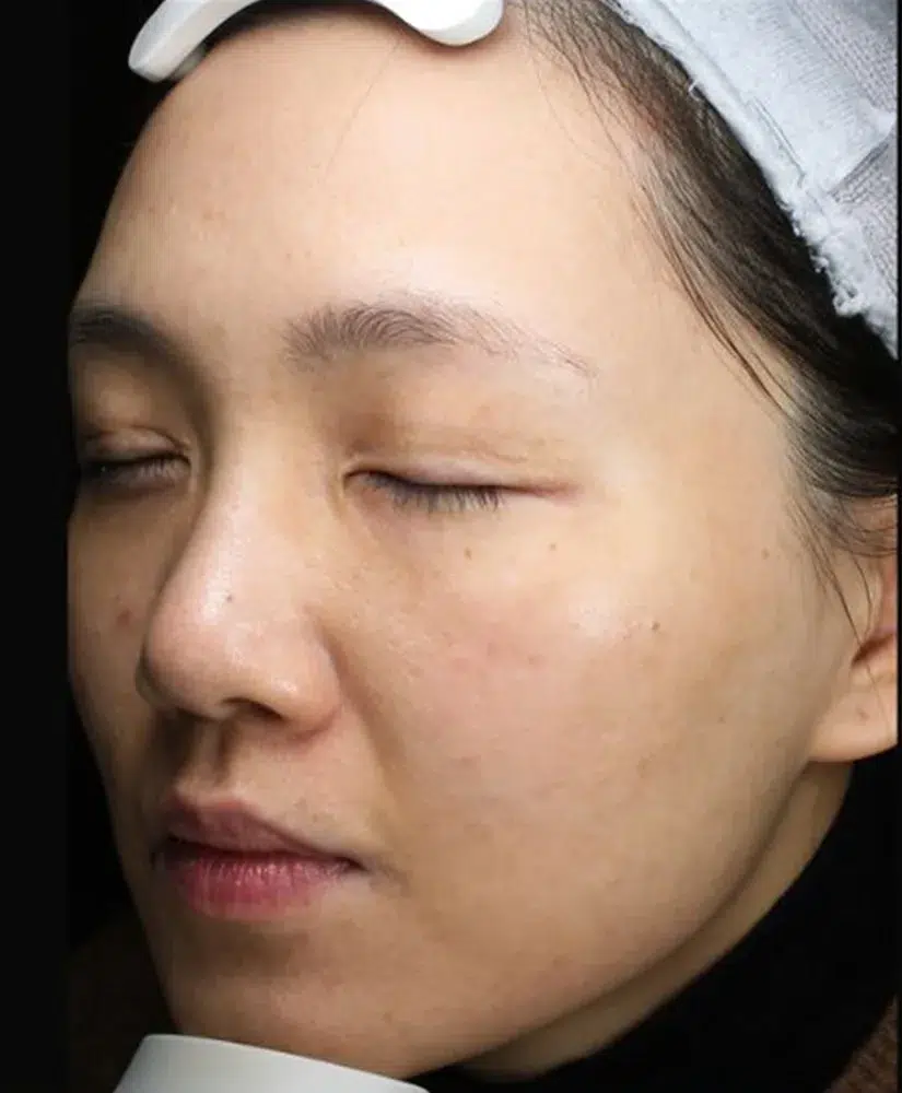Pigmentation post-treatment · Case 32 · Luowei Medical Aesthetics Clinic
