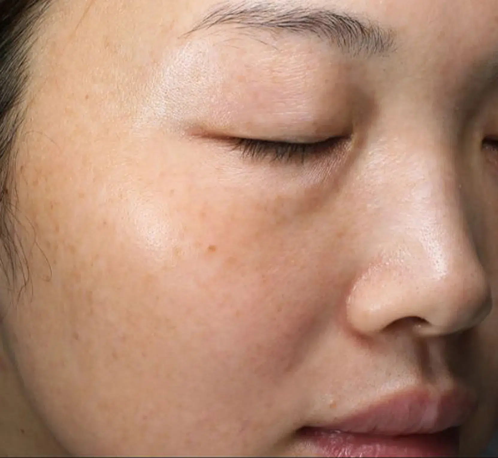 Pigmentation After · Case 33 · Luowei Medical Aesthetics Clinic