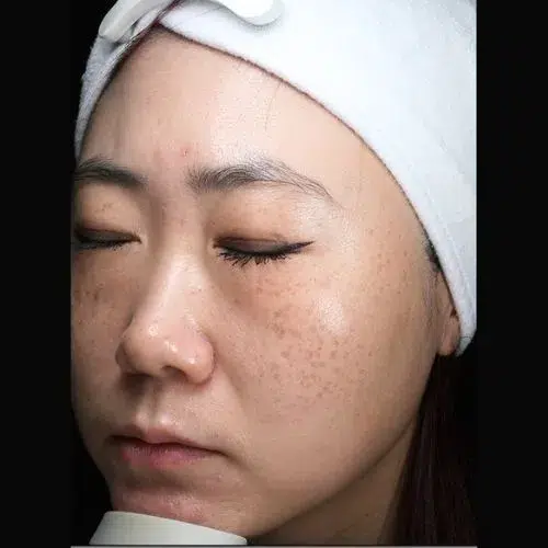 Hyperpigmentation Before · Case 03 · Luowei Medical Aesthetics Clinic