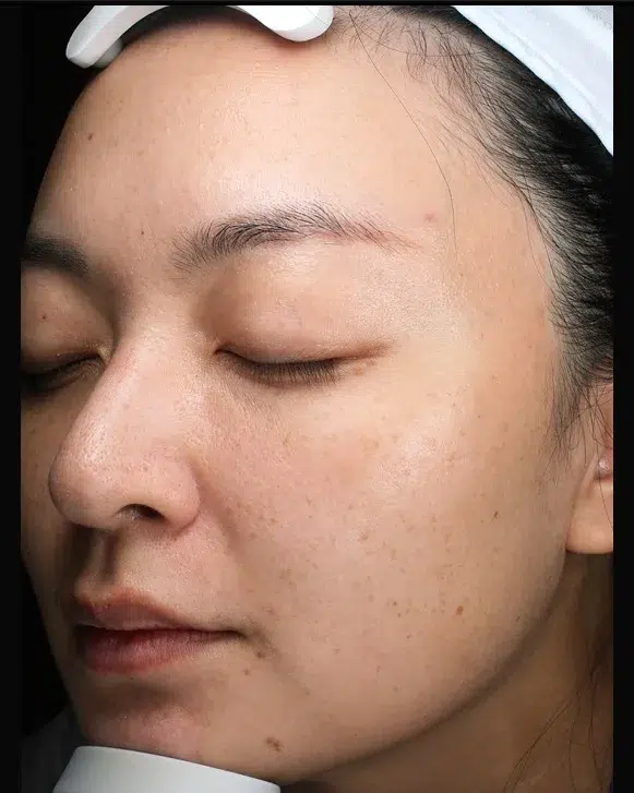Sun Damage / Photoaging Before-Treatment · Case 04 · Luowei Medical Aesthetics Clinic
