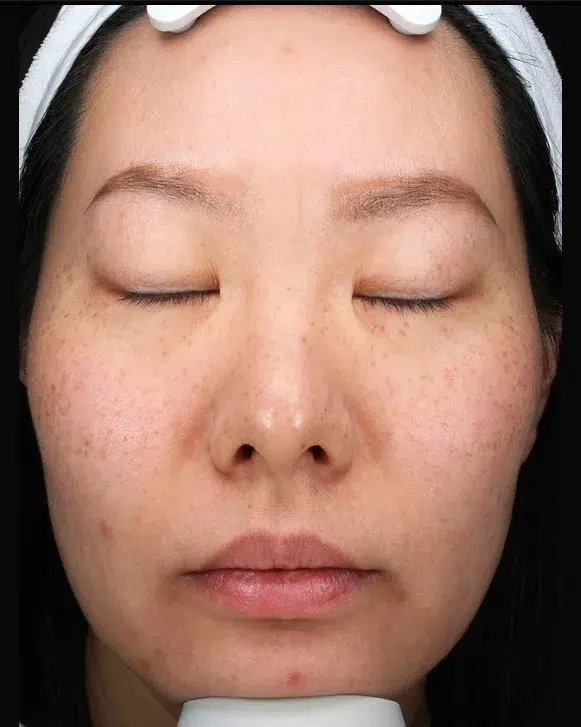 Sun Damage / Photoaging before · Case 05 · Luowei Medical Aesthetics Clinic