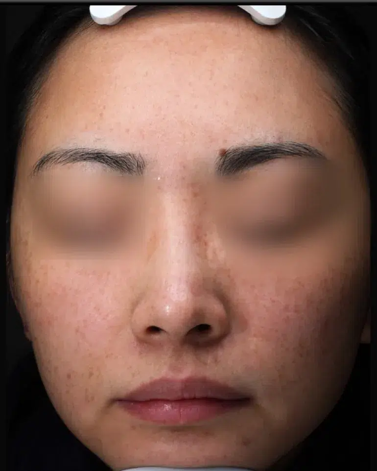 Sun Damage / Photoaging Before · Case 07 · Luowei Medical Aesthetics Clinic