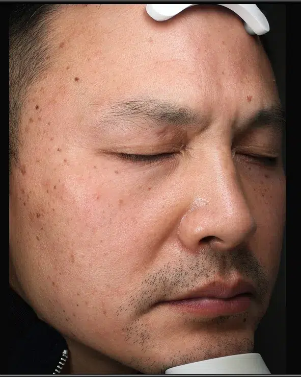 Sun Damage / Photoaging Before-Treatment · Case 09 · Luowei Medical Aesthetics Clinic