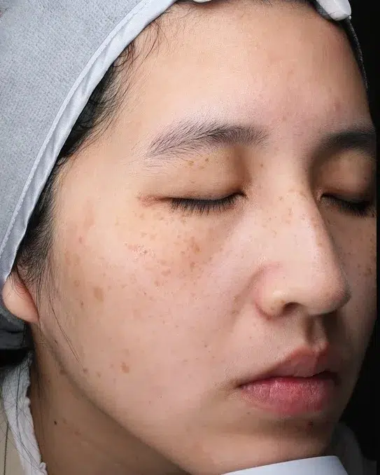 Freckles — Before · Case 24 · Luowei Medical Aesthetics Clinic