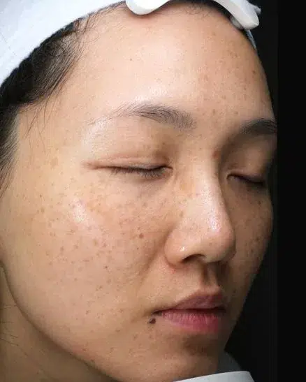Pigmentation pre-treatment · Case 12 · Luowei Medical Aesthetics Clinic