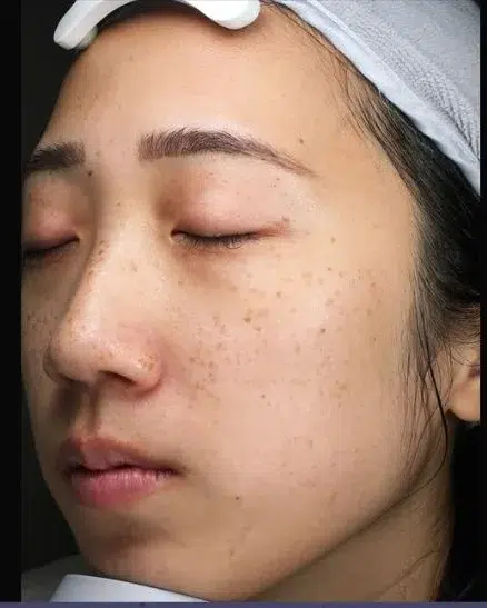 Pigmentation Before · Case 13 · Luowei Medical Aesthetics Clinic