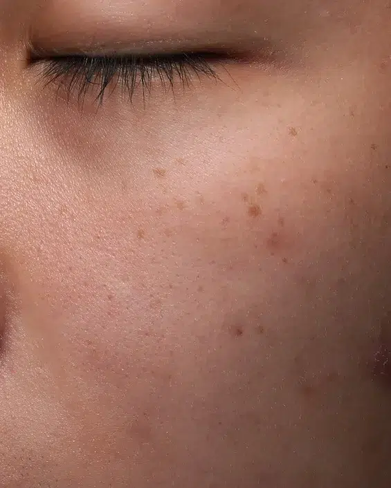 Freckles Before Treatment · Case 30 · Luowei Medical Aesthetics Clinic