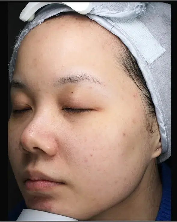 Hyperpigmentation Before · Case 16 · Luowei Medical Aesthetics Clinic