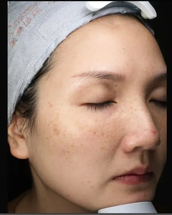 Sun Damage / Photoaging before · Case 17 · Luowei Medical Aesthetics Clinic