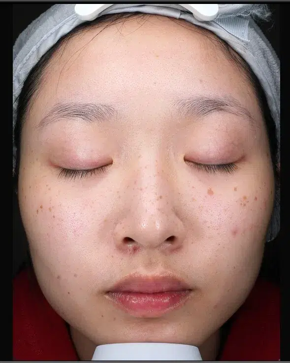 Freckles — Before Treatment · Case 19 · Luowei Medical Aesthetics Clinic