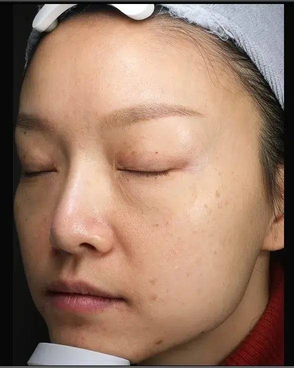 Sun Damage / Photoaging Before · Case 19 · Luowei Medical Aesthetics Clinic