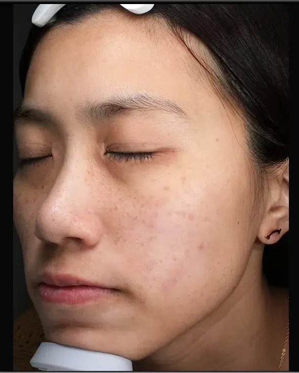 Sun Damage / Photoaging Before-Treatment · Case 20 · Luowei Medical Aesthetics Clinic