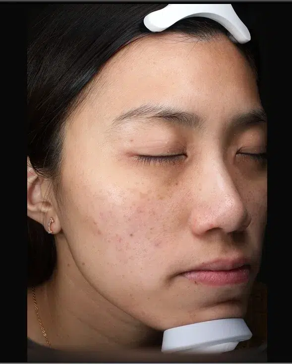 Post-Inflammatory Hyperpigmentation — Before Treatment · Case 21 · Luowei Medical Aesthetics Clinic