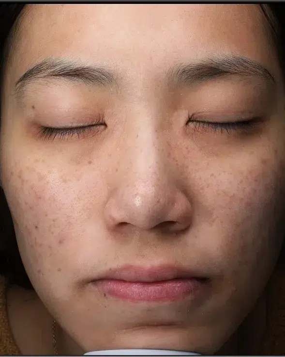 Post-Inflammatory Hyperpigmentation — Before Treatment · Case 22 · Luowei Medical Aesthetics Clinic