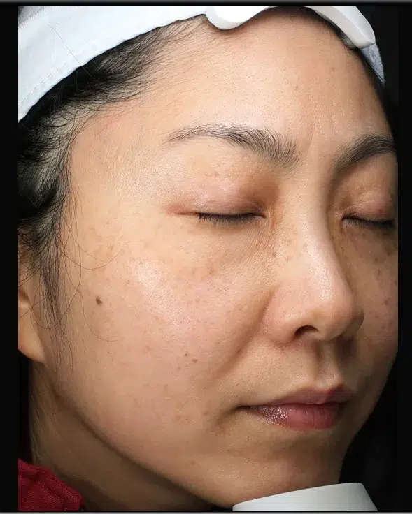 Sun Damage / Photoaging Before-Treatment · Case 29 · Luowei Medical Aesthetics Clinic