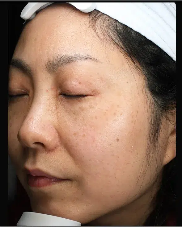 Sun Damage / Photoaging before · Case 31 · Luowei Medical Aesthetics Clinic