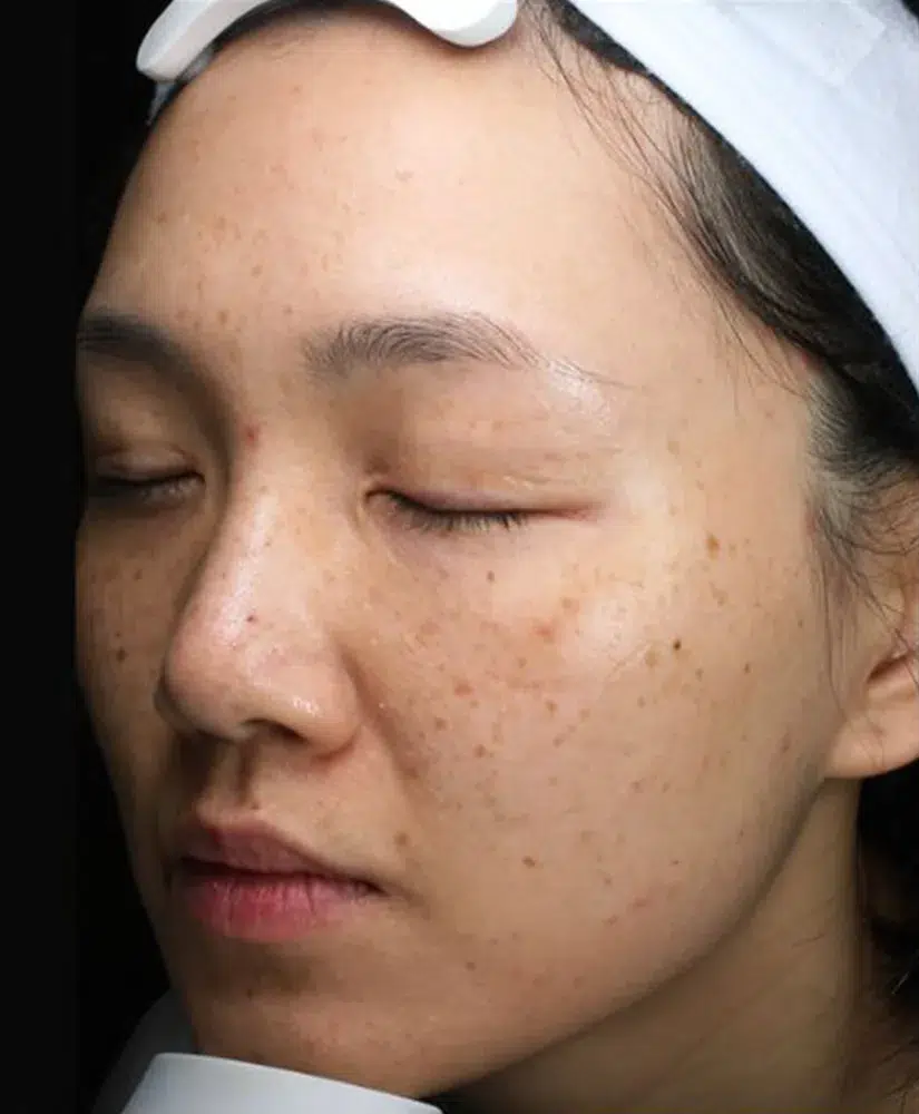 Hyperpigmentation Before · Case 32 · Luowei Medical Aesthetics Clinic